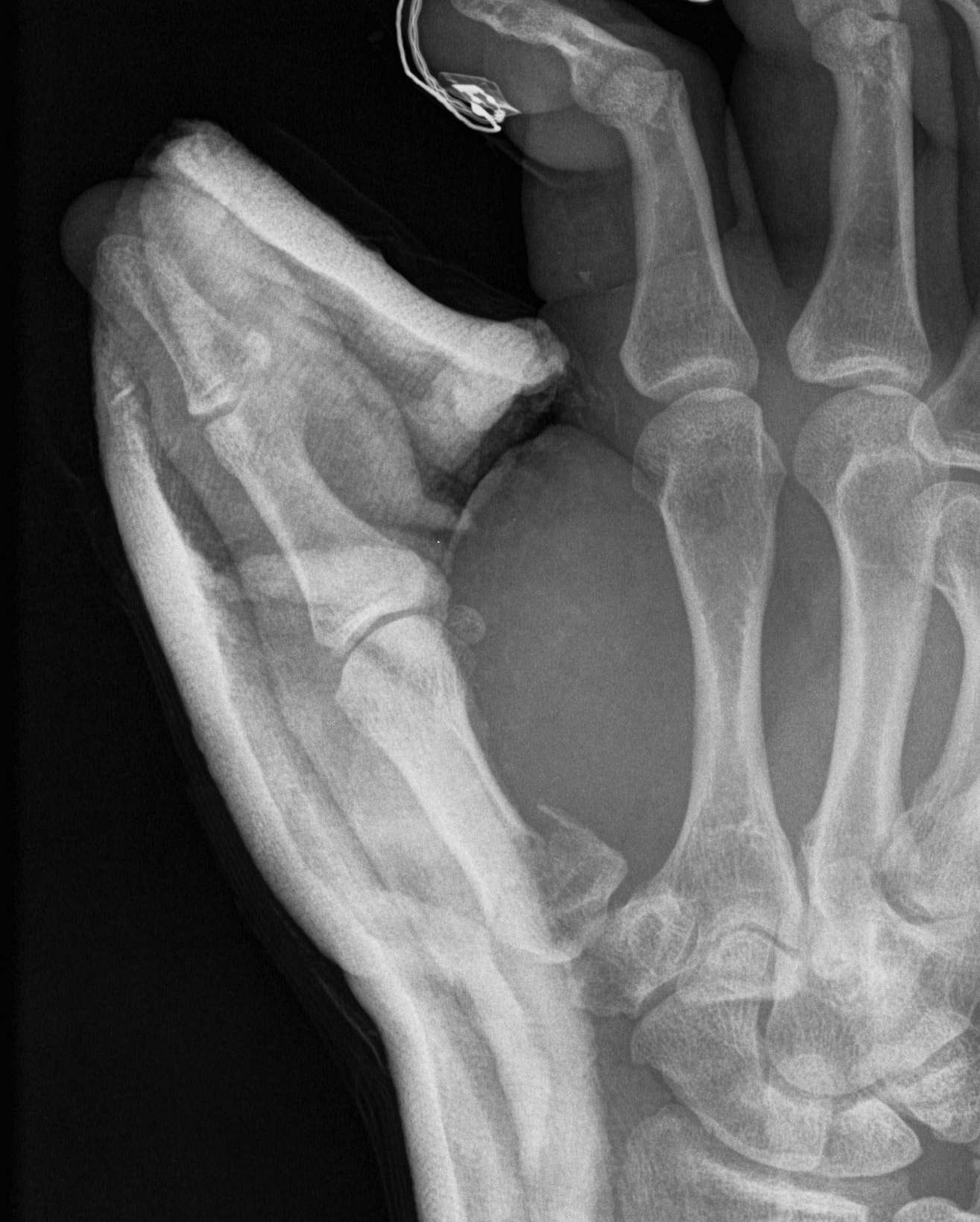 Bennetts Fracture Lateral